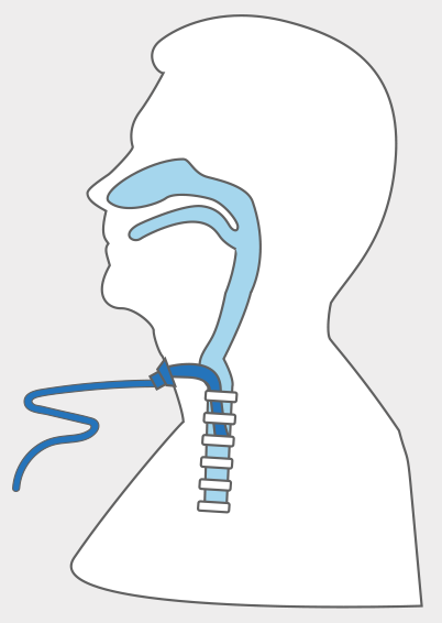 Tracheostomy